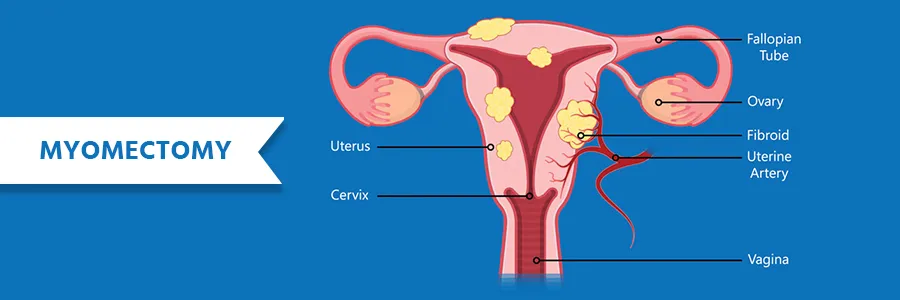 Myomectomy