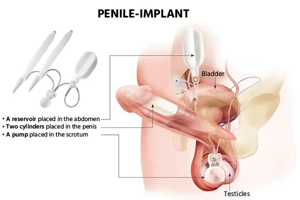 Penile Implant