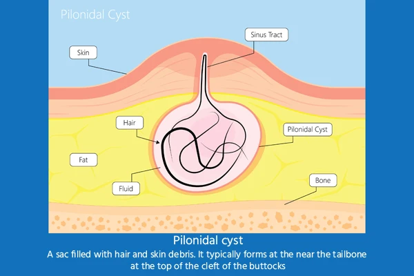 Pilonidal Sinus Surgery Cost