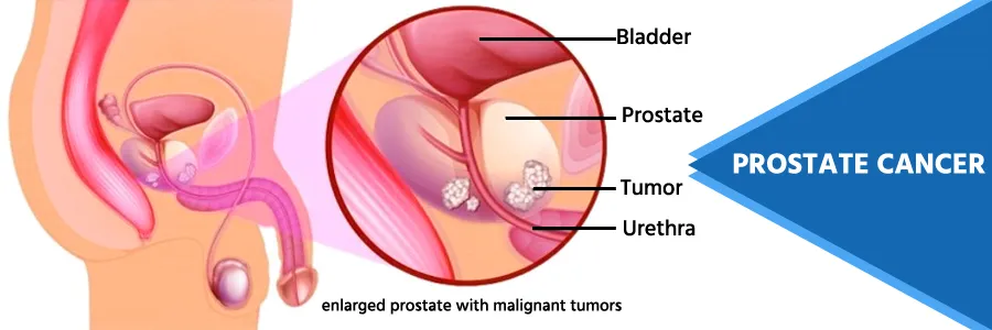 Prostate Cancer Treatment