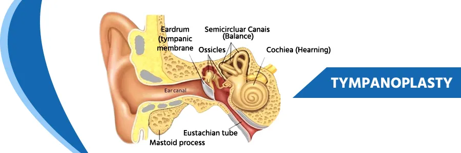 tympanoplasty