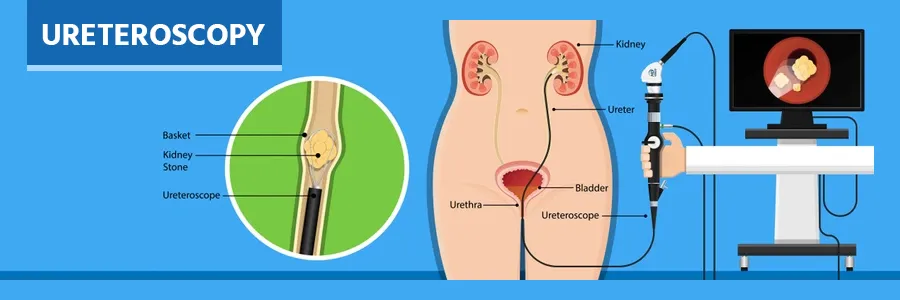 ureteroscopy-cost