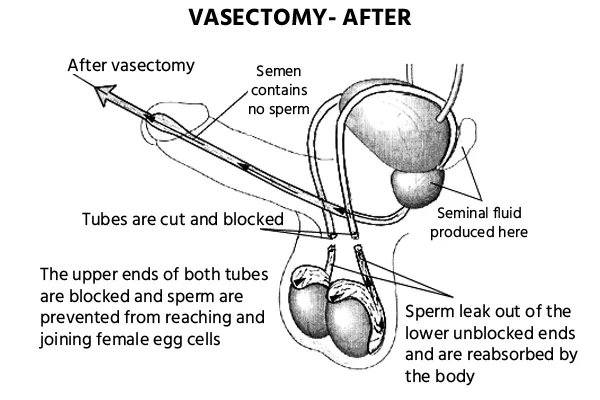 Vasectomy Reversal after