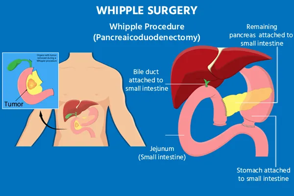 Whipple Surgery