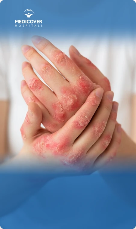 Natural Remedies for Eczema