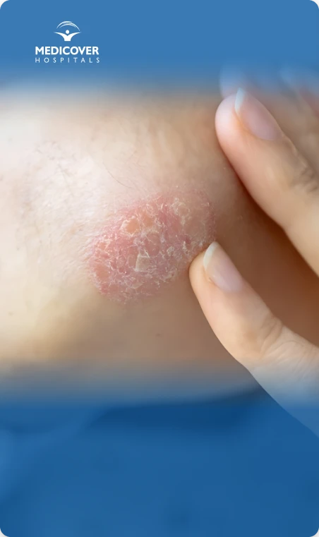 Red, scaly patches on skin