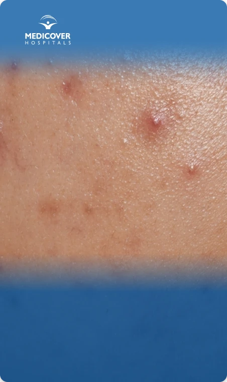 Skin lesions and numbness