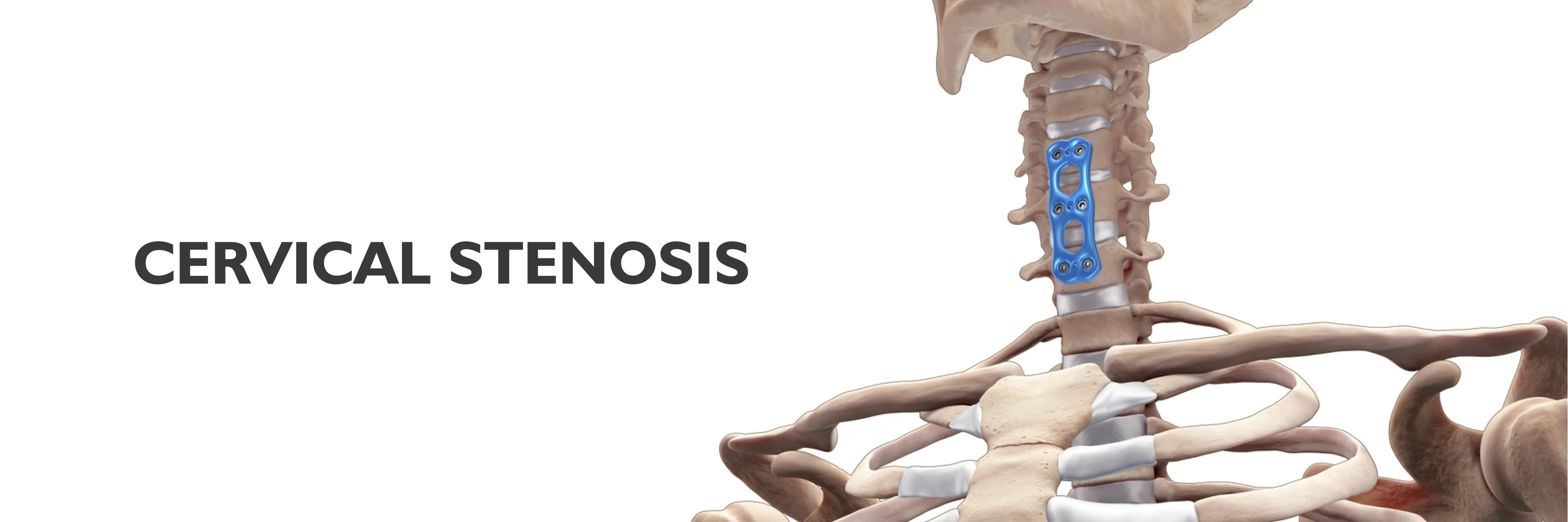 Cervical Stenosis Causes Symptoms Prevention And Treatment 