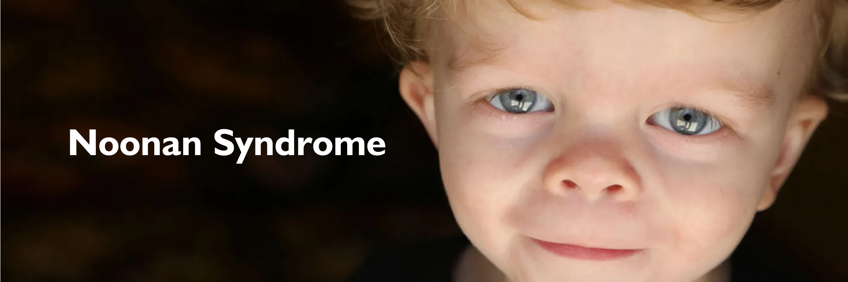 Noonan Syndrome