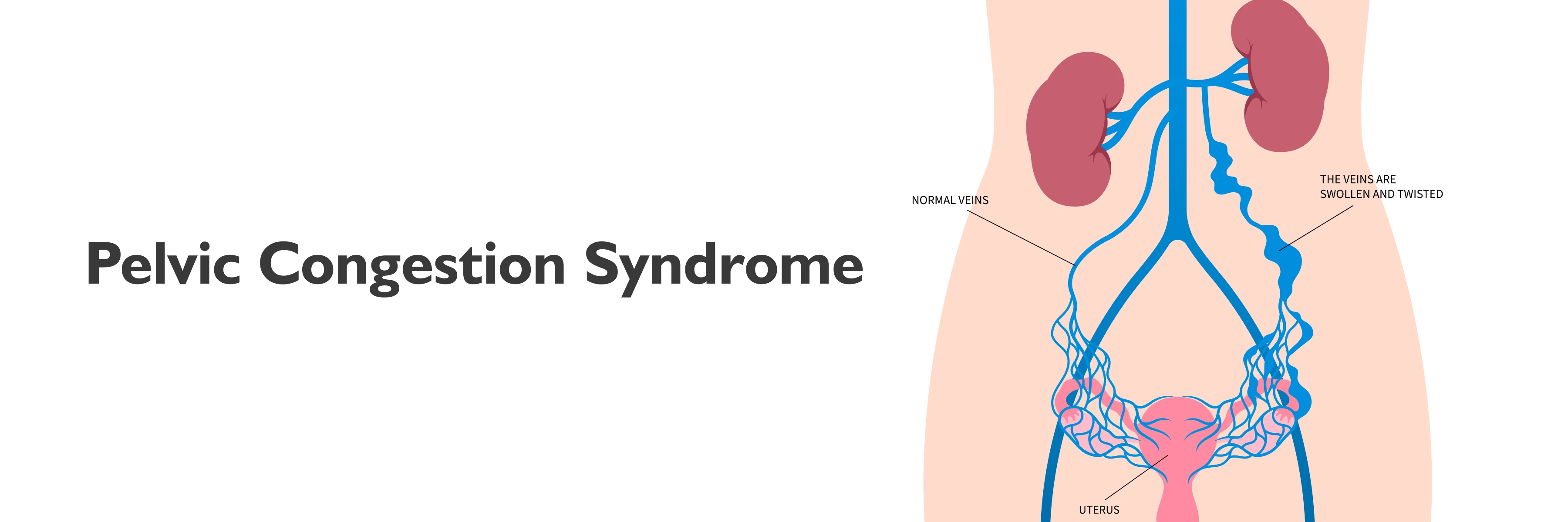 Pelvic Congestion Syndrome