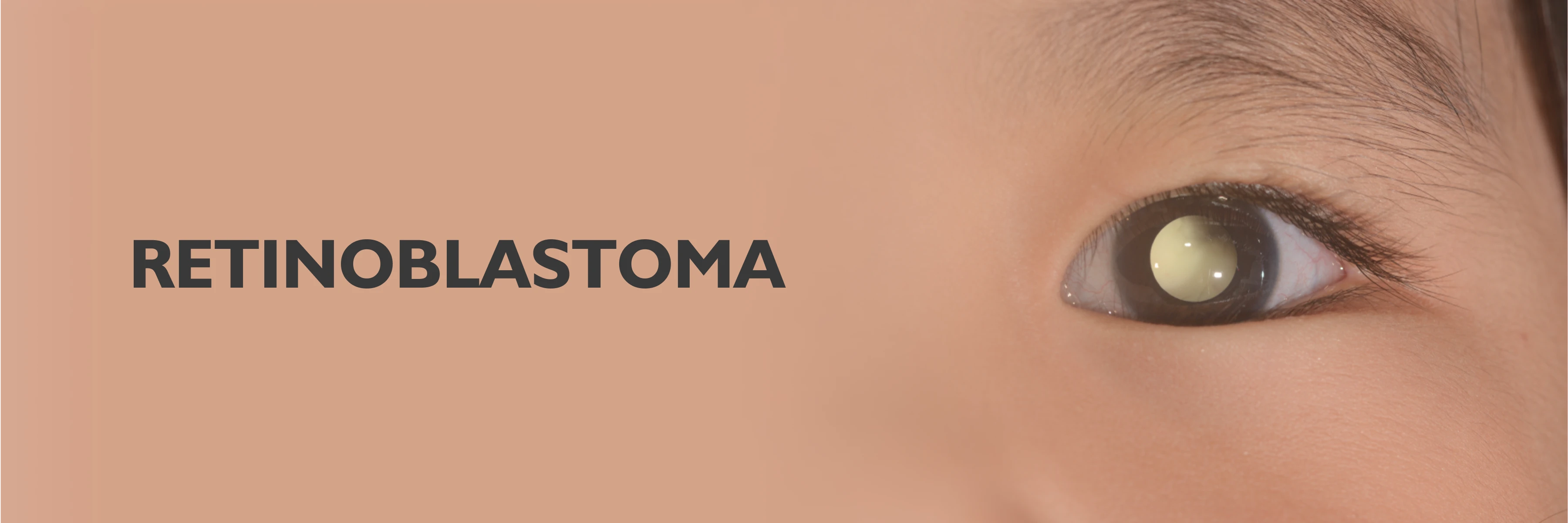 Retinoblastoma