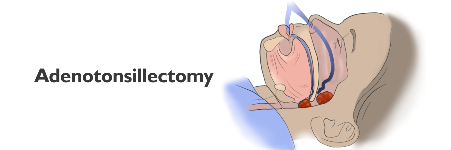 Adenotonsillectomy Overview