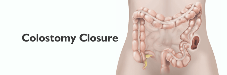 Colostomy Closure