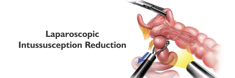 Laparoscopic Intussusception Reduction