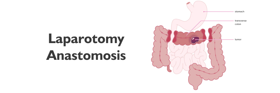 Laparotomy Anastomosis