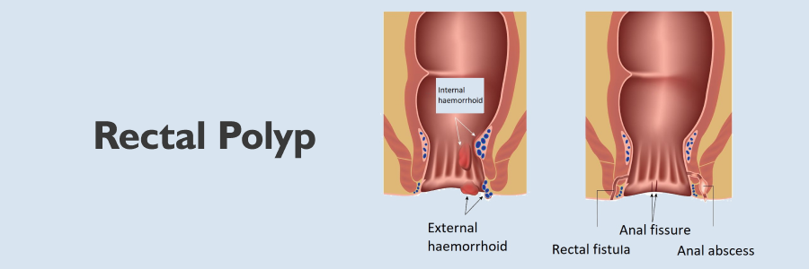 Rectal Polyps