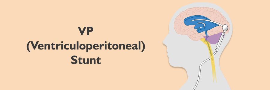 VP (ventriculoperitoneal) Shunt: Indications, Procedure & Recovery